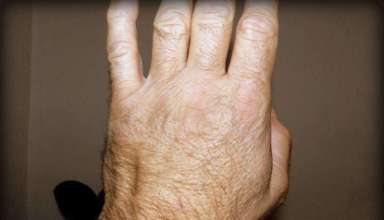 Prirodni lijek protiv upale zglobova