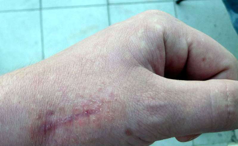 Krema za uklanjanje ožiljaka